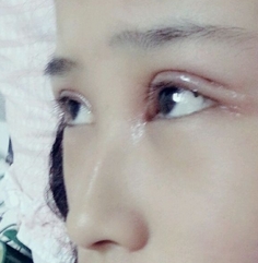 术后