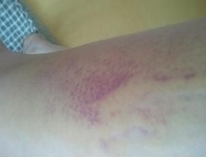 大腿吸脂术后第二天