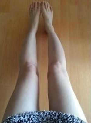 吸脂术后效果