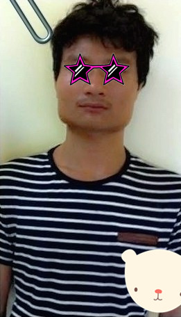 下颧骨整形手术的案例