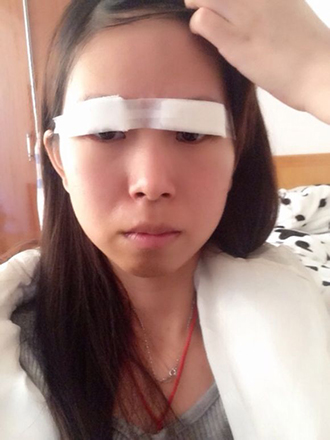 双眼皮手术的案例