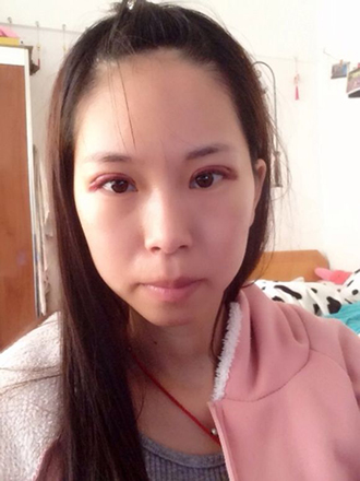 双眼皮手术的案例