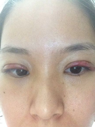 双眼皮手术的案例