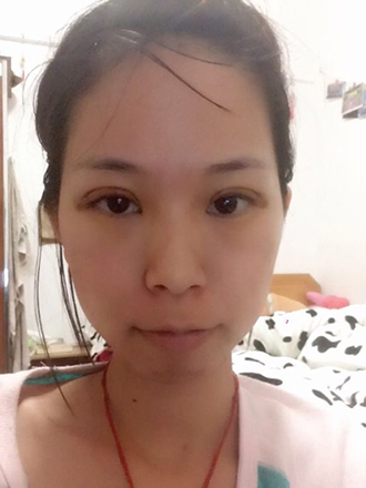 双眼皮手术的案例
