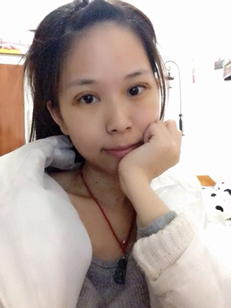 双眼皮手术的案例