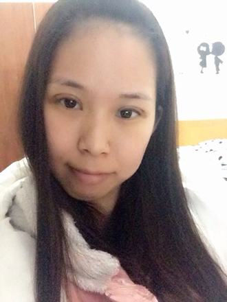 双眼皮手术的案例