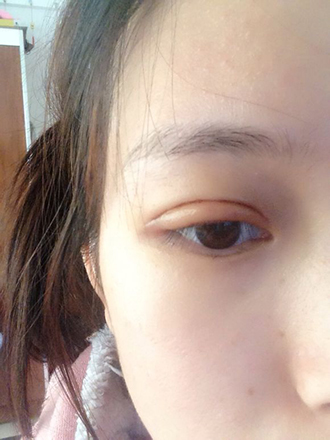 双眼皮手术的案例