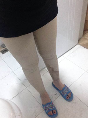大腿吸脂的案例