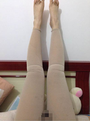 大腿吸脂的案例