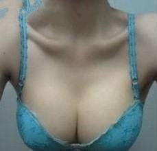 隆胸