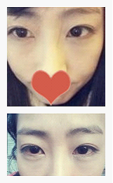 术后