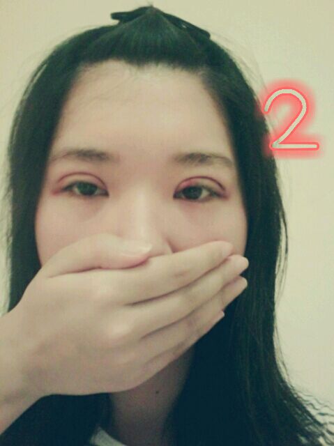 双眼皮