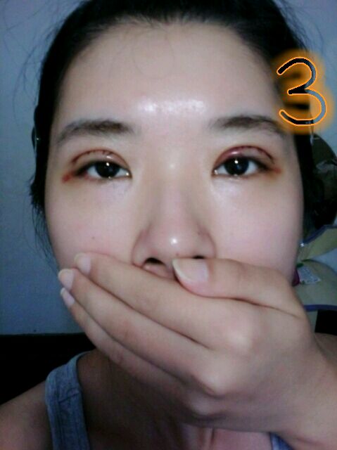 双眼皮