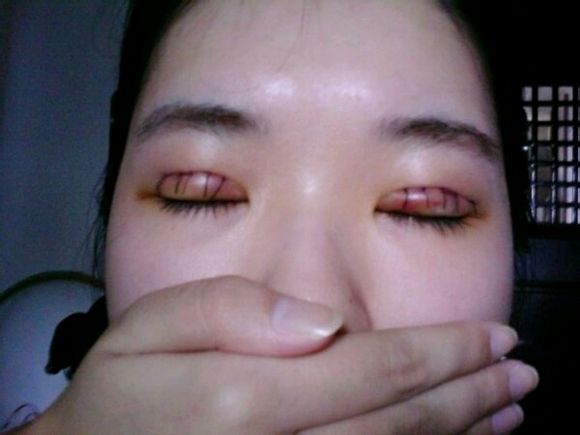 双眼皮