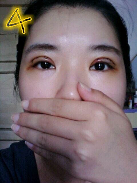 双眼皮