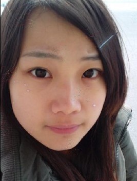 激光祛痘
