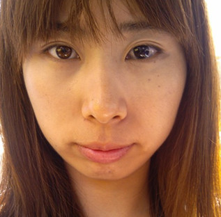 激光去除太田痣变回俏脸蛋