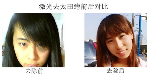 激光去除太田痣变回俏脸蛋
