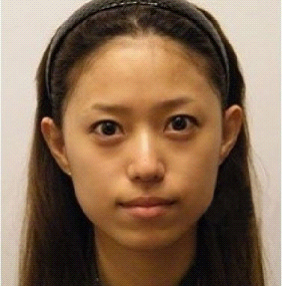 整容手术前