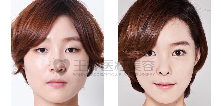 双眼皮术前术后对比照片.jpg