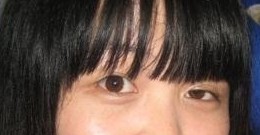 上脸下垂手术的真实案例