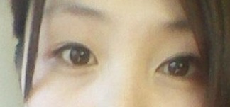 上脸下垂手术的真实案例