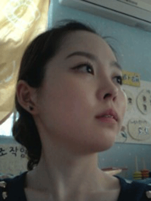 颧骨整形手术