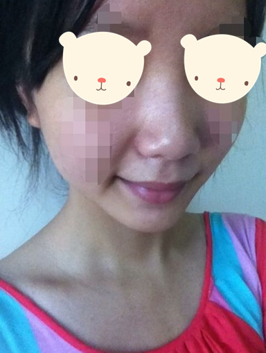 注射隆鼻的手术案例