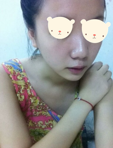 注射隆鼻的手术案例
