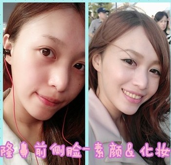 隆鼻前的抓抓